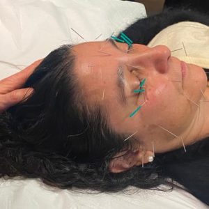 Photograph of lady having facial revitalisation acupuncture treatment.