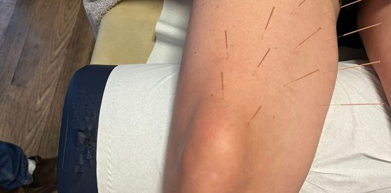 Needles in upper leg during Master Tung Acupuncture treatment