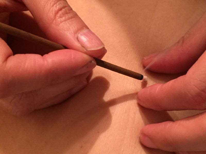A photo showing a practitioner applying rice grain moxa to their patient's skin.