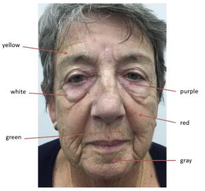An older white lady's face. Each area of the face is labelled with the different organ zones.