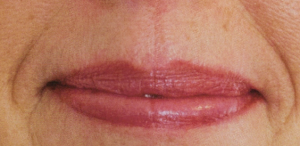 lips with red discolouration in the area just above